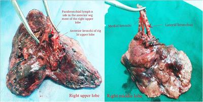 Lymph node metastases outside tumor-bearing lobes and/or segments in non–small cell lung cancer